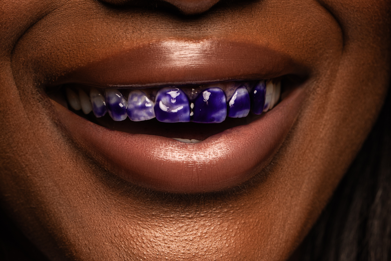 Stylo de blanchiment V34 et PAP